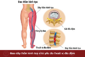 Đau Dây Thần Kinh Tọa Là Gì? Mẹo Dân Gian Giảm Đau Hiệu Quả